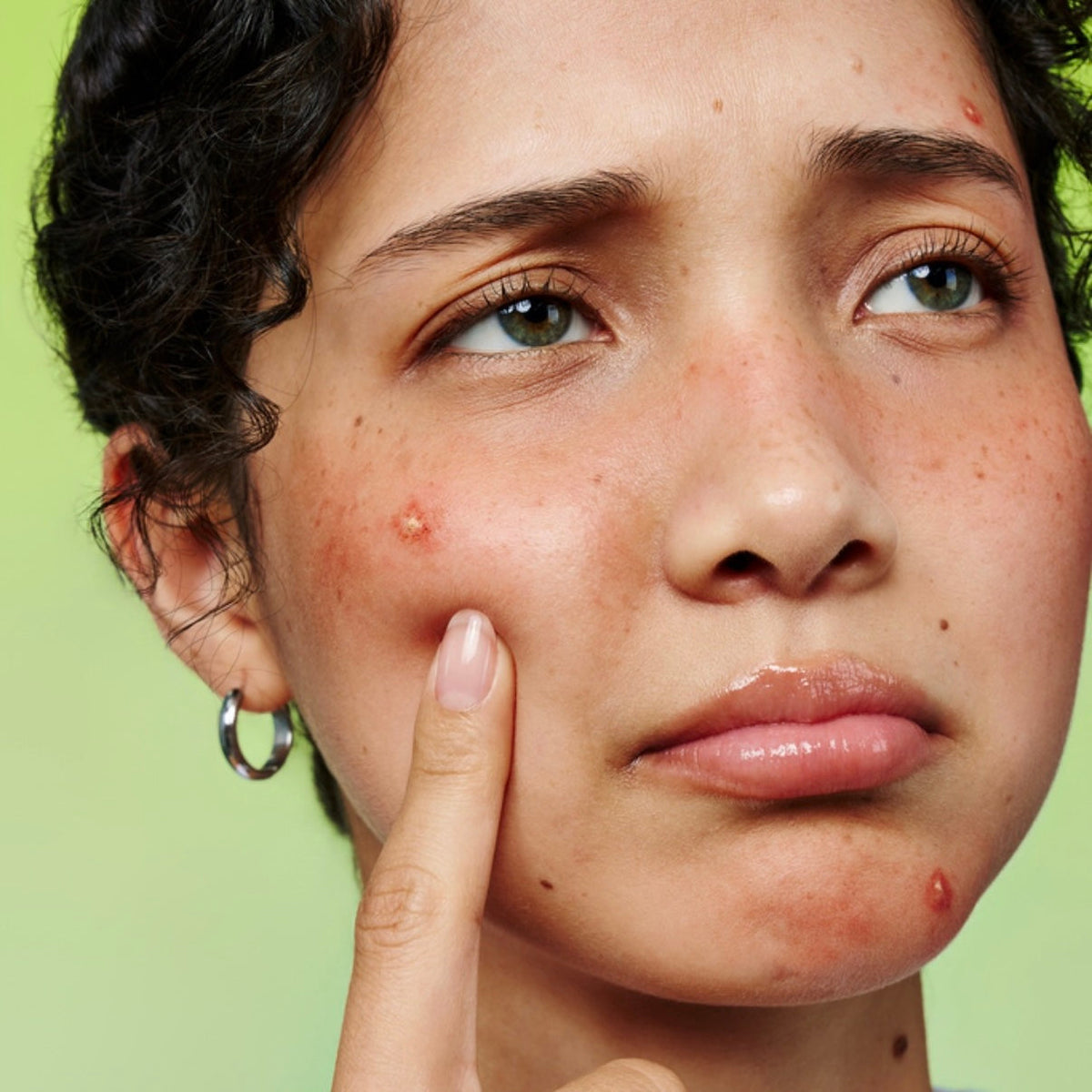 Close-up of a face with skin concerns: a red, inflamed blemish on the cheek, another on the chin, scattered smaller spots on the forehead, and light redness across the cheeks and nose, against a green background.