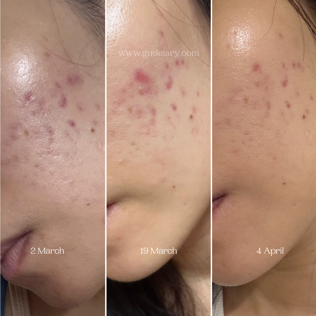 Fade Acne Scars and Hyperpigmentation with numbuzin No.5 Line