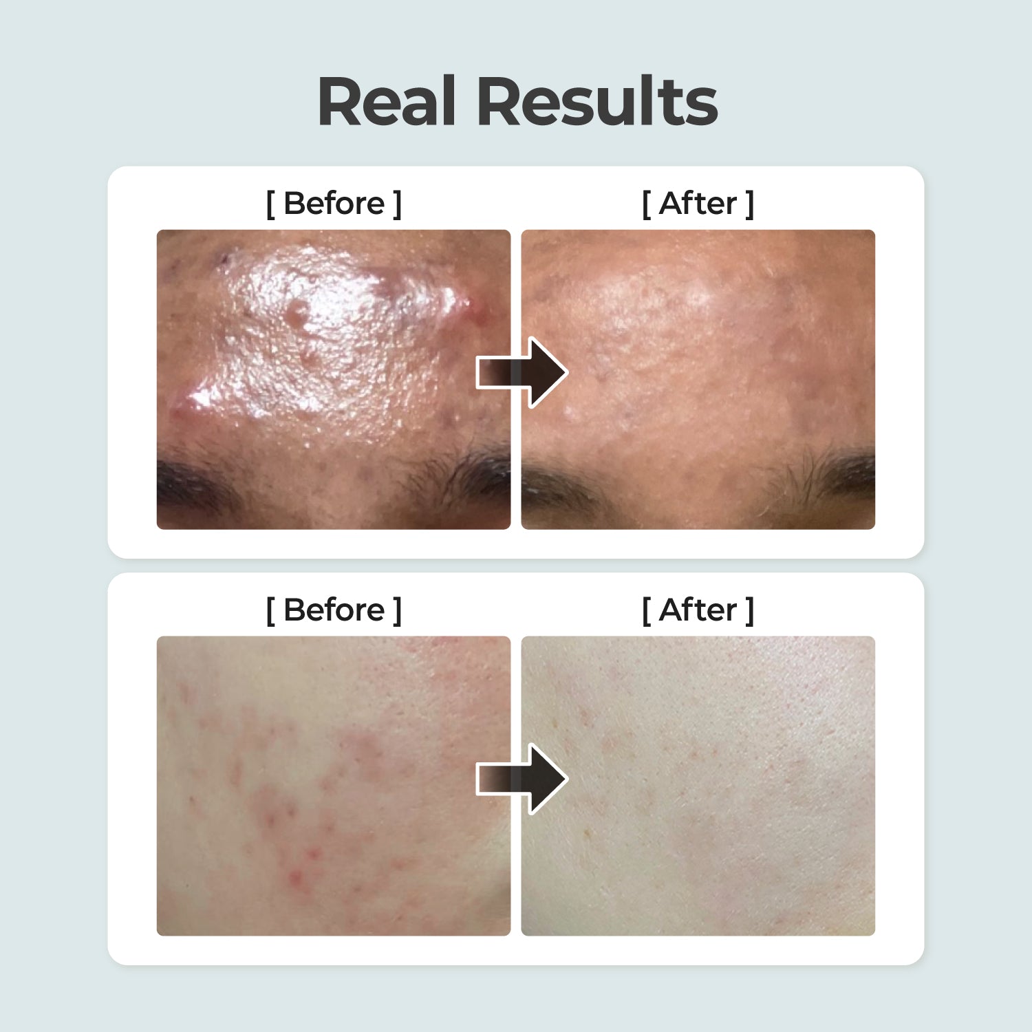 No.1 Breakout-Free Clear Skin Duo